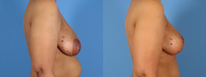 Before & After Breast Lift Case 28307 Right Side View in Alpharetta, GA