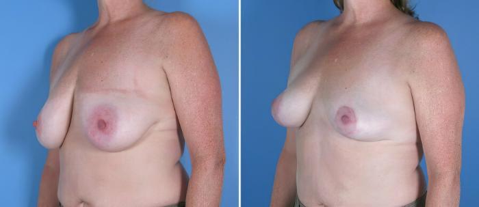 Before & After Breast Reduction Case 17954 View #1 View in Alpharetta, GA