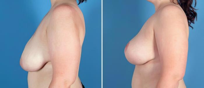 Before & After Breast Reduction Case 25624 View #2 View in Alpharetta, GA