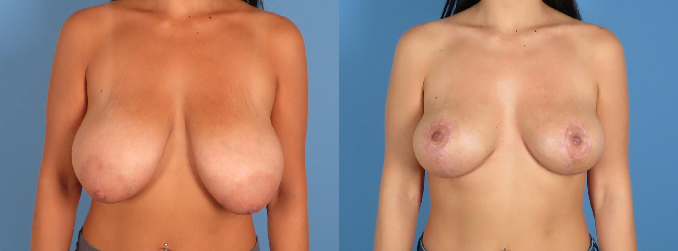 Before & After Breast Reduction Case 28313 Front View in Atlanta, GA