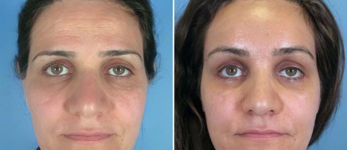Before & After Brow Lift Case 17449 View #1 View in Alpharetta, GA