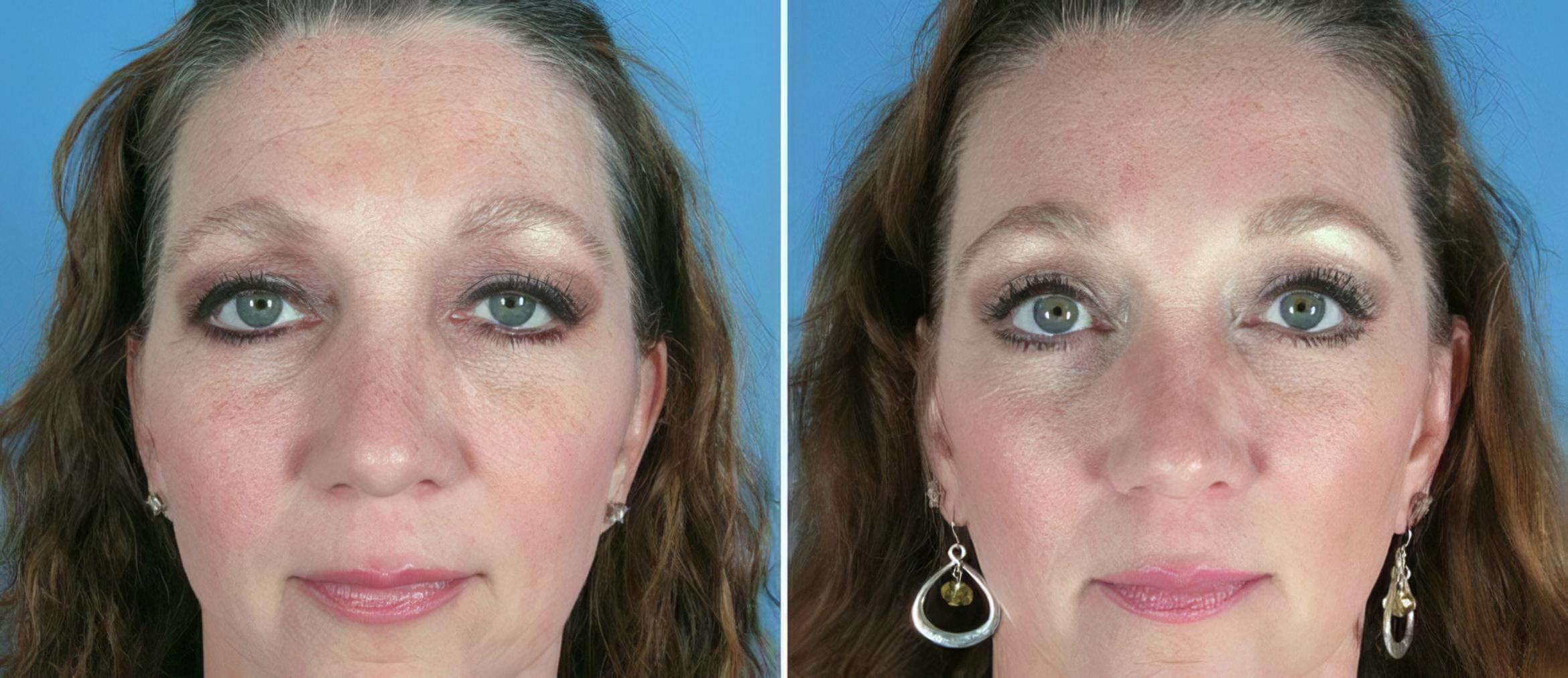 Before & After Brow Lift Case 17451 View #1 View in Alpharetta, GA