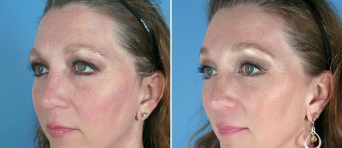 Before & After Brow Lift Case 17451 View #2 View in Alpharetta, GA