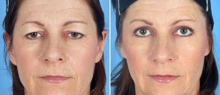 Before & After Brow Lift Case 17454 View #1 View in Alpharetta, GA