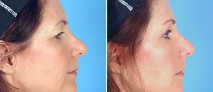 Before & After Brow Lift Case 17454 View #2 View in Alpharetta, GA