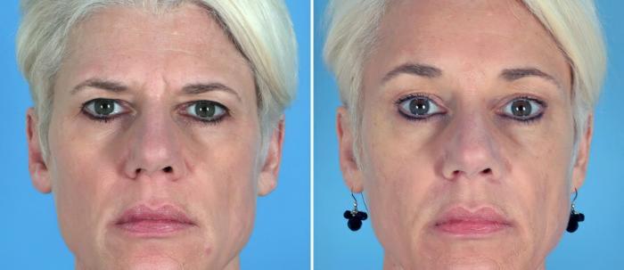Before & After Brow Lift Case 17459 View #1 View in Alpharetta, GA