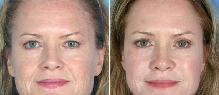 Before & After Brow Lift Case 17462 View #1 View in Alpharetta, GA