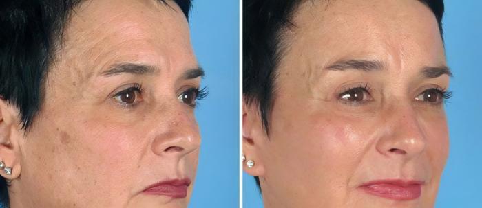 Before & After Brow Lift Case 19548 View #2 View in Alpharetta, GA