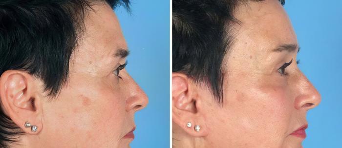 Before & After Brow Lift Case 19548 View #3 View in Alpharetta, GA
