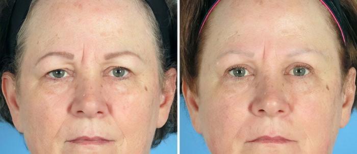 Before & After Brow Lift Case 19552 View #1 View in Alpharetta, GA