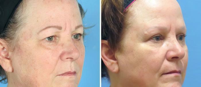 Before & After Brow Lift Case 19552 View #2 View in Alpharetta, GA
