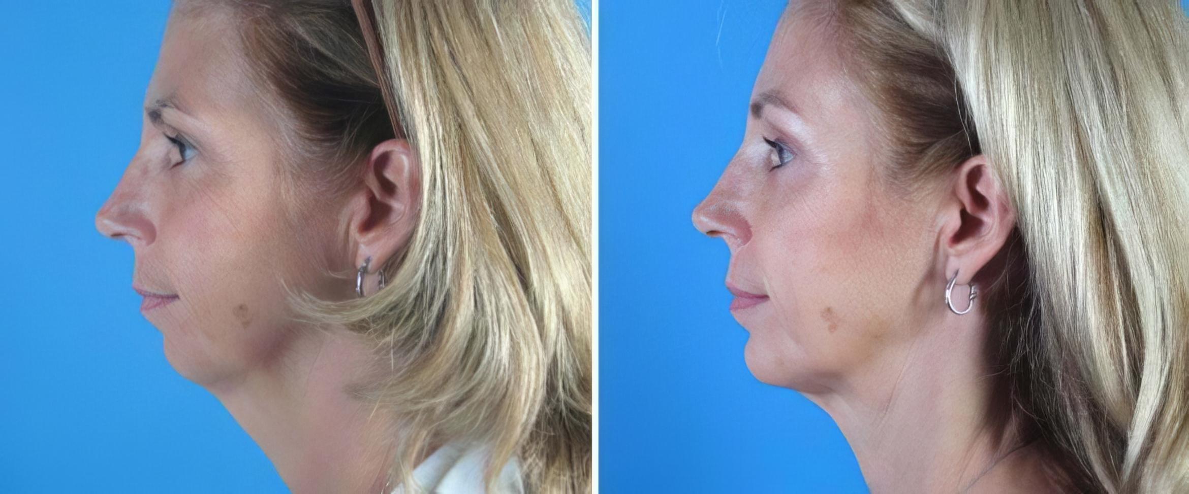 Before & After Chin Augmentation / Neck Lift Case 18145 View #1 View in Alpharetta, GA