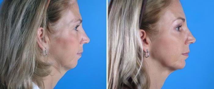 Before & After Chin Augmentation / Neck Lift Case 18145 View #2 View in Alpharetta, GA
