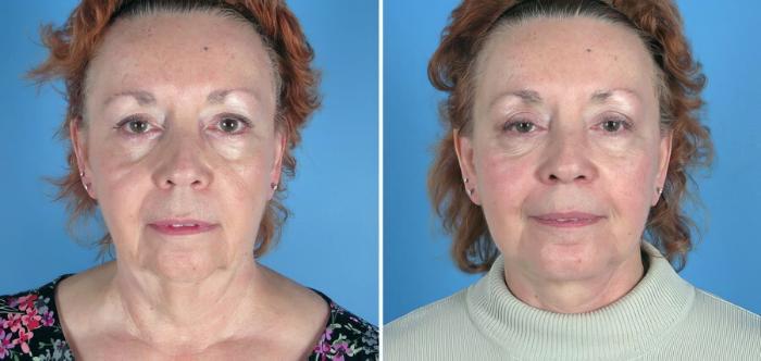 Before & After Chin & Neck Liposuction Case 17734 View #1 View in Alpharetta, GA