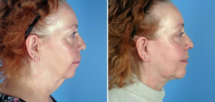 Before & After Chin & Neck Liposuction Case 17734 View #2 View in Alpharetta, GA