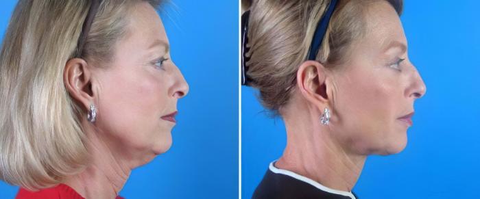 Before & After Chin & Neck Liposuction Case 19341 View #1 View in Alpharetta, GA