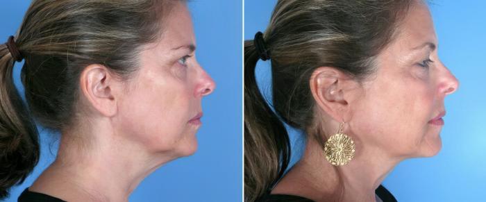 Before & After Chin & Neck Liposuction Case 19364 View #1 View in Alpharetta, GA