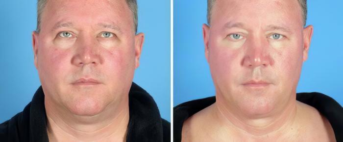 Before & After Chin & Neck Liposuction Case 25519 View #1 View in Alpharetta, GA