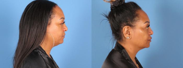 Before & After Chin & Neck Liposuction Case 28306 Right Side View in Alpharetta, GA