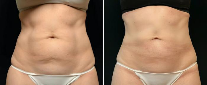 Before & After CoolSculpting Case 17801 View #1 View in Alpharetta, GA