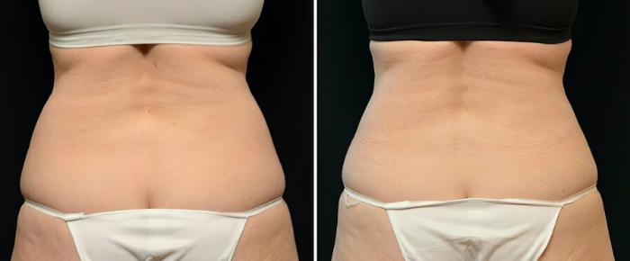 Before & After CoolSculpting Case 17801 View #2 View in Alpharetta, GA