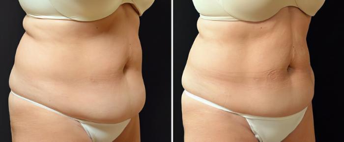 Before & After CoolSculpting Case 17804 View #1 View in Alpharetta, GA