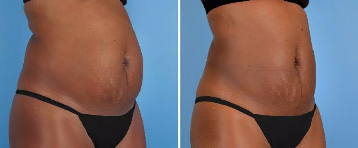 Before & After CoolSculpting Case 17806 View #1 View in Alpharetta, GA