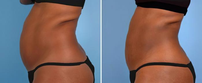 Before & After CoolSculpting Case 17806 View #2 View in Alpharetta, GA