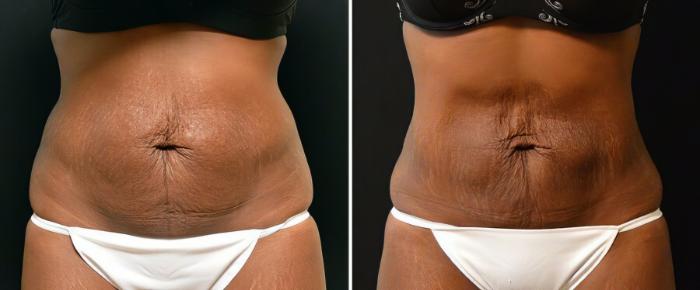 Before & After CoolSculpting Case 17809 View #1 View in Alpharetta, GA
