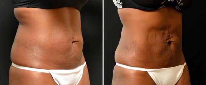 Before & After CoolSculpting Case 17809 View #2 View in Alpharetta, GA