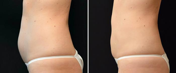Before & After CoolSculpting Case 17812 View #1 View in Alpharetta, GA