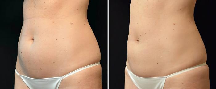Before & After CoolSculpting Case 17812 View #2 View in Alpharetta, GA