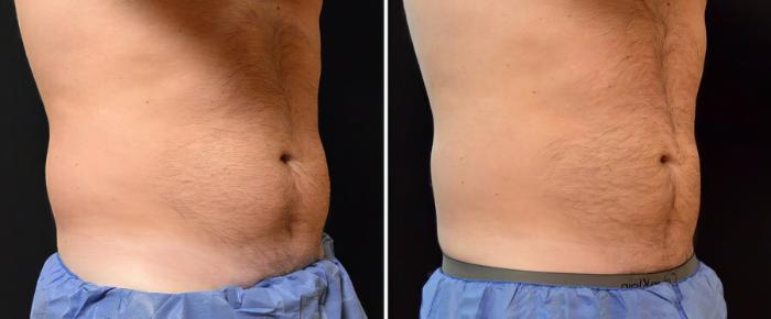 Before & After CoolSculpting Case 17878 View #1 View in Alpharetta, GA