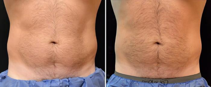 Before & After CoolSculpting Case 17878 View #2 View in Alpharetta, GA