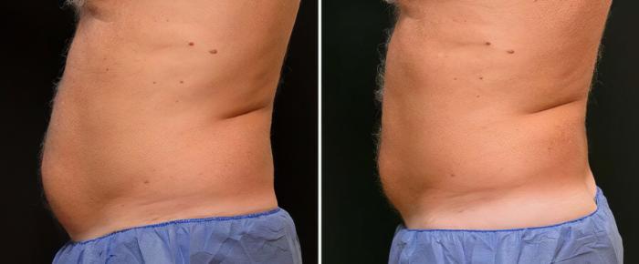 Before & After CoolSculpting Case 17881 View #1 View in Alpharetta, GA