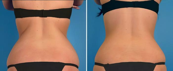 Before & After CoolSculpting Case 17883 View #1 View in Alpharetta, GA