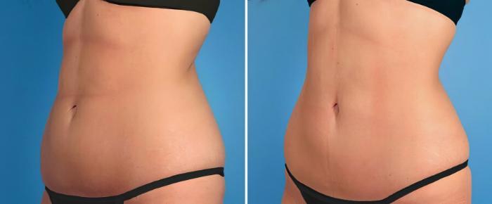 Before & After CoolSculpting Case 17883 View #2 View in Alpharetta, GA