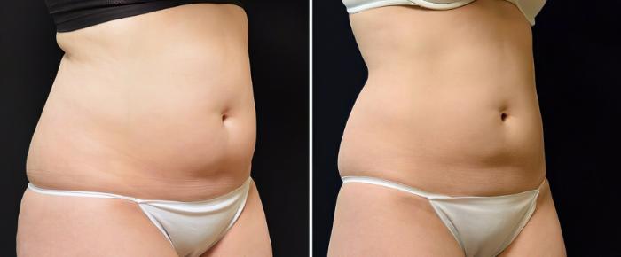 Before & After CoolSculpting Case 19056 View #1 View in Alpharetta, GA