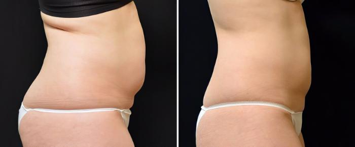 Before & After CoolSculpting Case 19056 View #2 View in Alpharetta, GA
