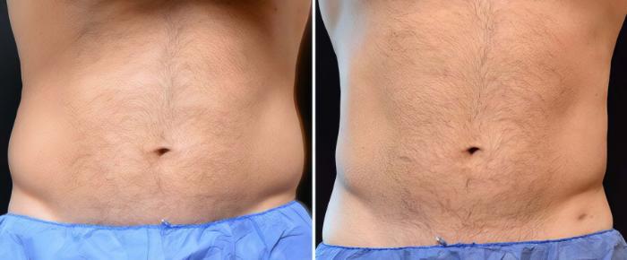 Before & After CoolSculpting Case 19059 View #1 View in Alpharetta, GA