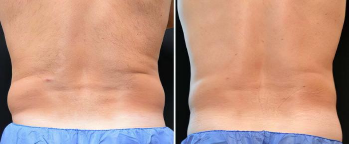 Before & After CoolSculpting Case 19059 View #2 View in Alpharetta, GA