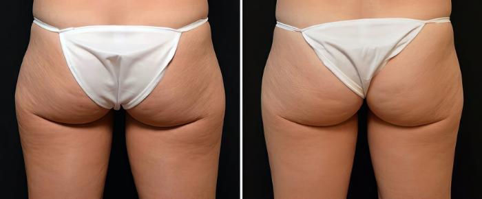 Before & After CoolSculpting Case 19062 View #1 View in Alpharetta, GA