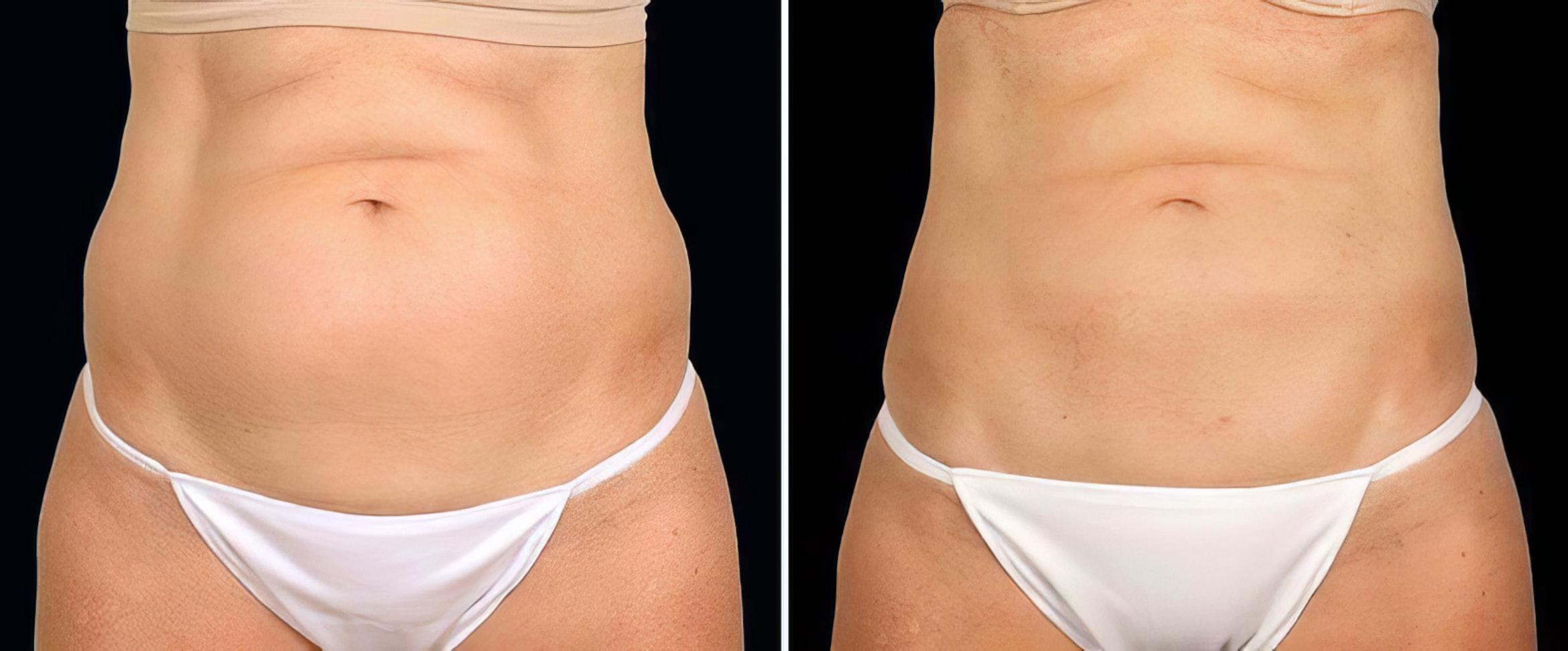 Before & After CoolSculpting Case 19064 View #1 View in Alpharetta, GA
