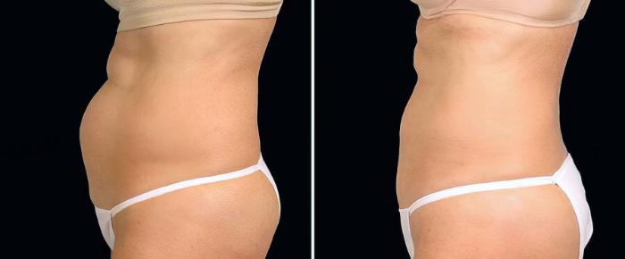 Before & After CoolSculpting Case 19064 View #2 View in Alpharetta, GA