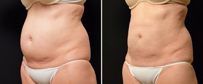 Before & After CoolSculpting Case 19067 View #1 View in Alpharetta, GA