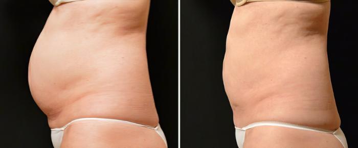 Before & After CoolSculpting Case 19067 View #2 View in Alpharetta, GA