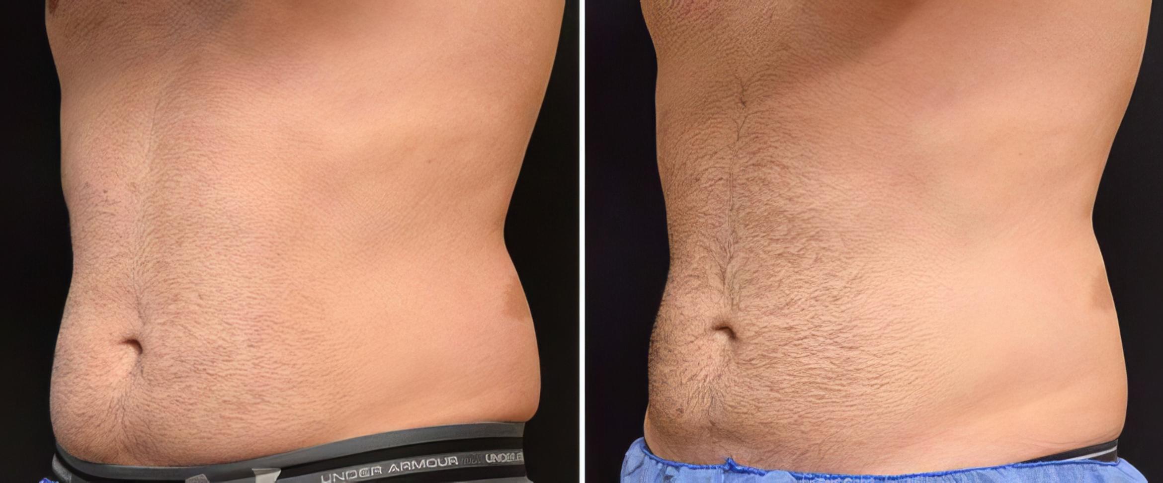 Before & After CoolSculpting Case 19070 View #1 View in Alpharetta, GA