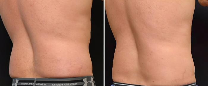 Before & After CoolSculpting Case 19070 View #2 View in Alpharetta, GA