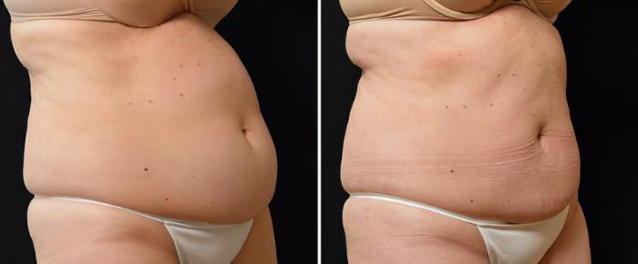 Before & After CoolSculpting Case 19075 View #1 View in Alpharetta, GA