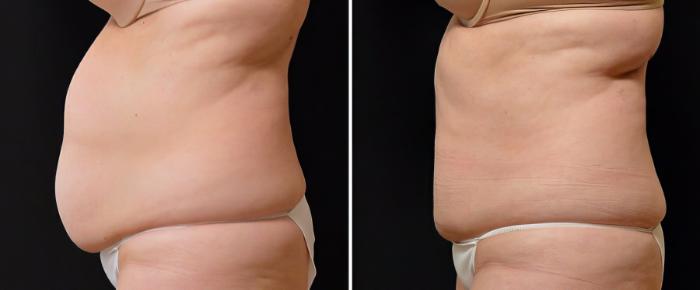 Before & After CoolSculpting Case 19075 View #2 View in Alpharetta, GA